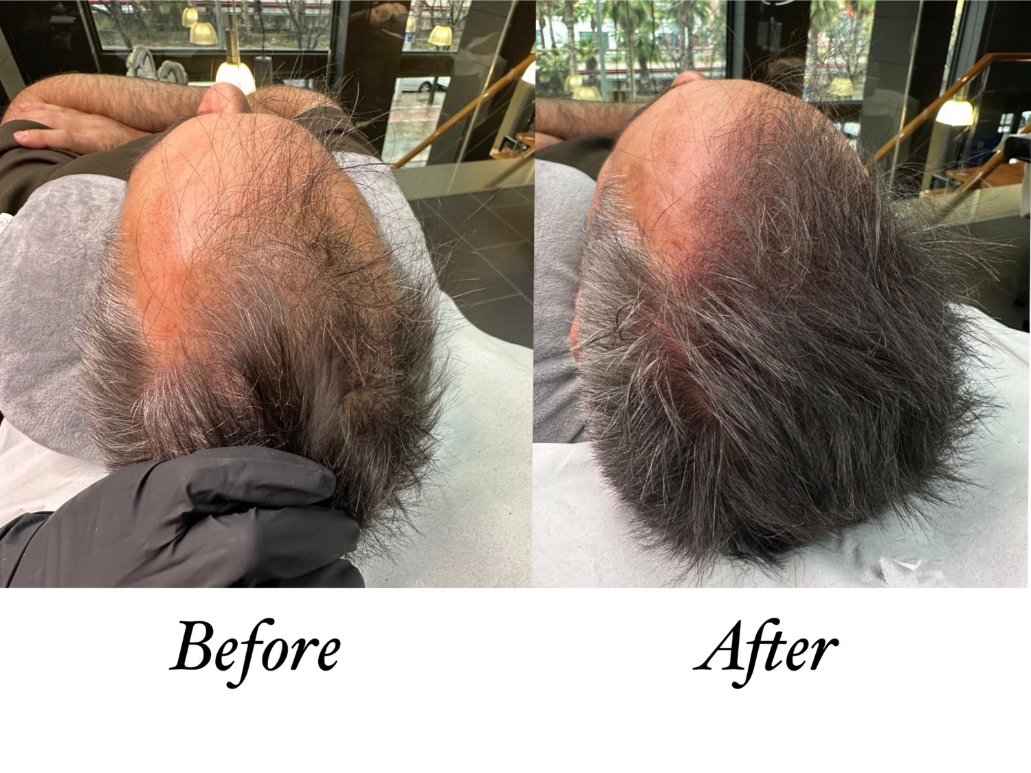 Resultado antes y después de micropigmentación capilar en Éxodo 47